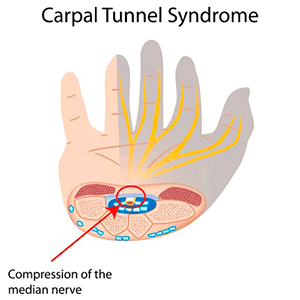 diagram showing Carpal tunnel syndrome.